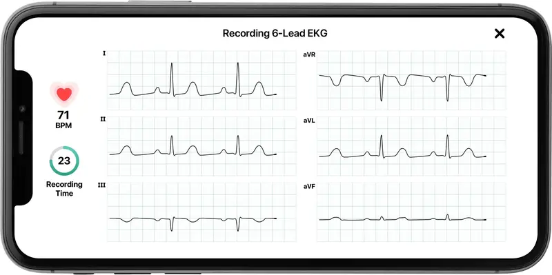 KardiaMobile 6L Personal EKG Device – FDA-Cleared 6-Lead Heart Monitor for Smartphone Integration